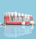 שתלים במקום שיניים: הדרך הבטוחה לחיוך מלא-תמונה